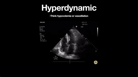 lv hyperdynamic|hyperdynamic left ventricle symptoms.